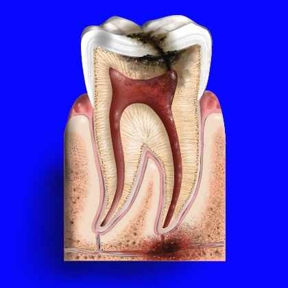 Bệnh sâu răng - Nguyên nhân và cách điều trị